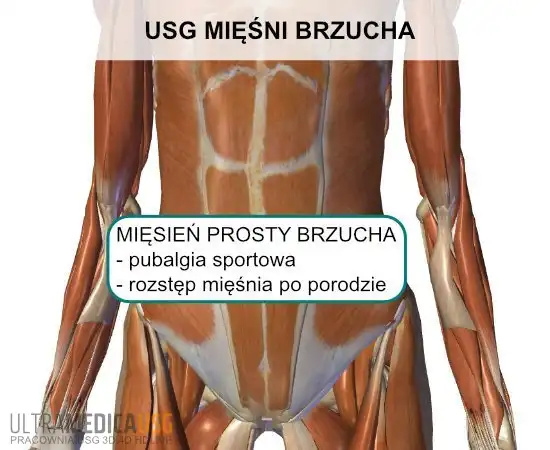 Mięsień prosty brzucha Mięsień prosty brzucha
