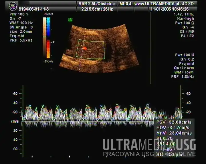 USG ciąży, 1 trymestr, 12. tydzień, Prawidłowa fala tętna w przewodzie żylnym Prawidłowa fala tętna w przewodzie żylnym, USG ciąży, 1 trymestr, 12. tydzień, Kraków