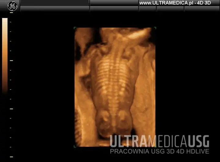 Kręgosłup płodu, ULTRAMEDICA, Kraków Kręgosłup płodu, ULTRAMEDICA, Kraków