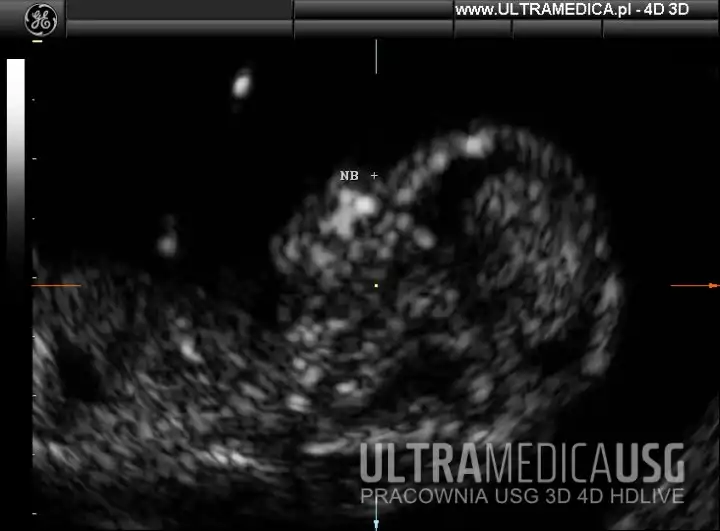 USG ciąży, 1 trymestr, kość nosowa NB Kość nosowa (NB), USG ciąży, 1 trymestr, Kraków