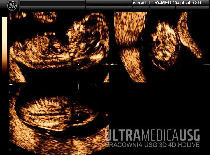 USG ciąży, 1 trymestr, przezierność karku, NT Przezierność karku (NT), USG ciąży, 1 trymestr, Kraków