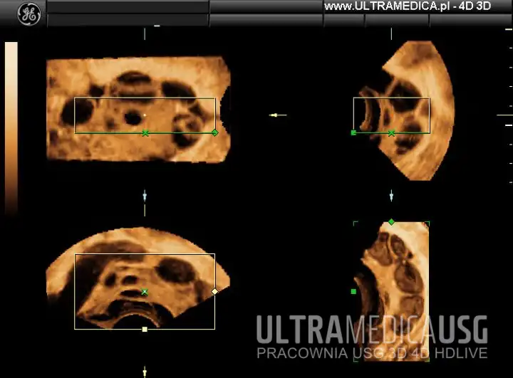 USG ginekologiczne - zmiana na jajniku